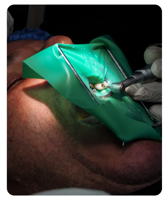 Implantes Dentales en Colombia