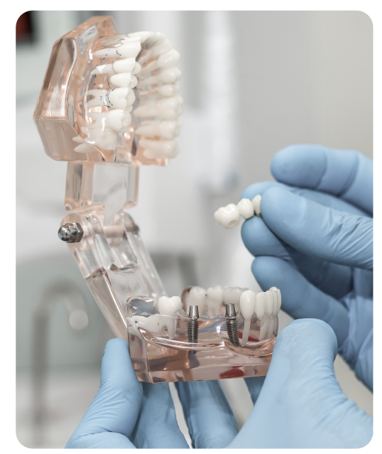 Implantes dentales en Barranquilla