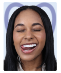 diseño de sonrisa Barranquilla