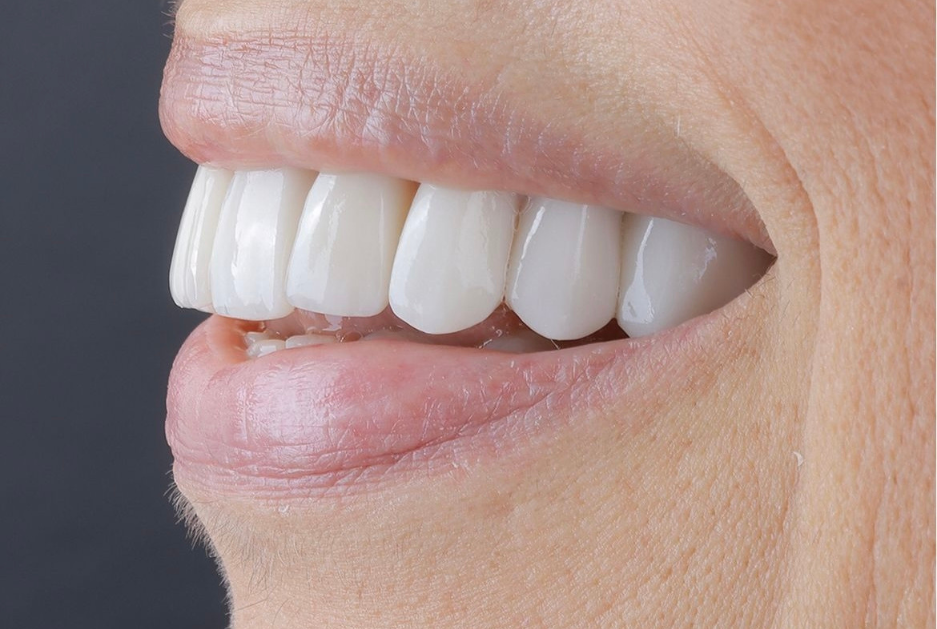 implantes dentales en Colombia
