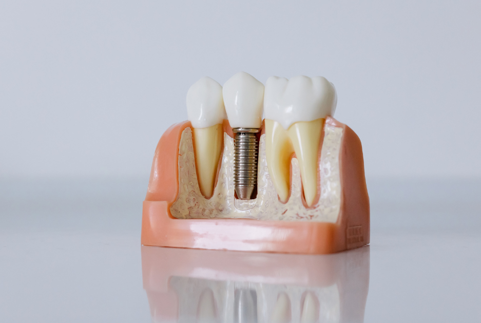 implantes dentales